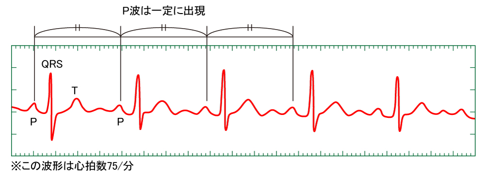 正常洞調律