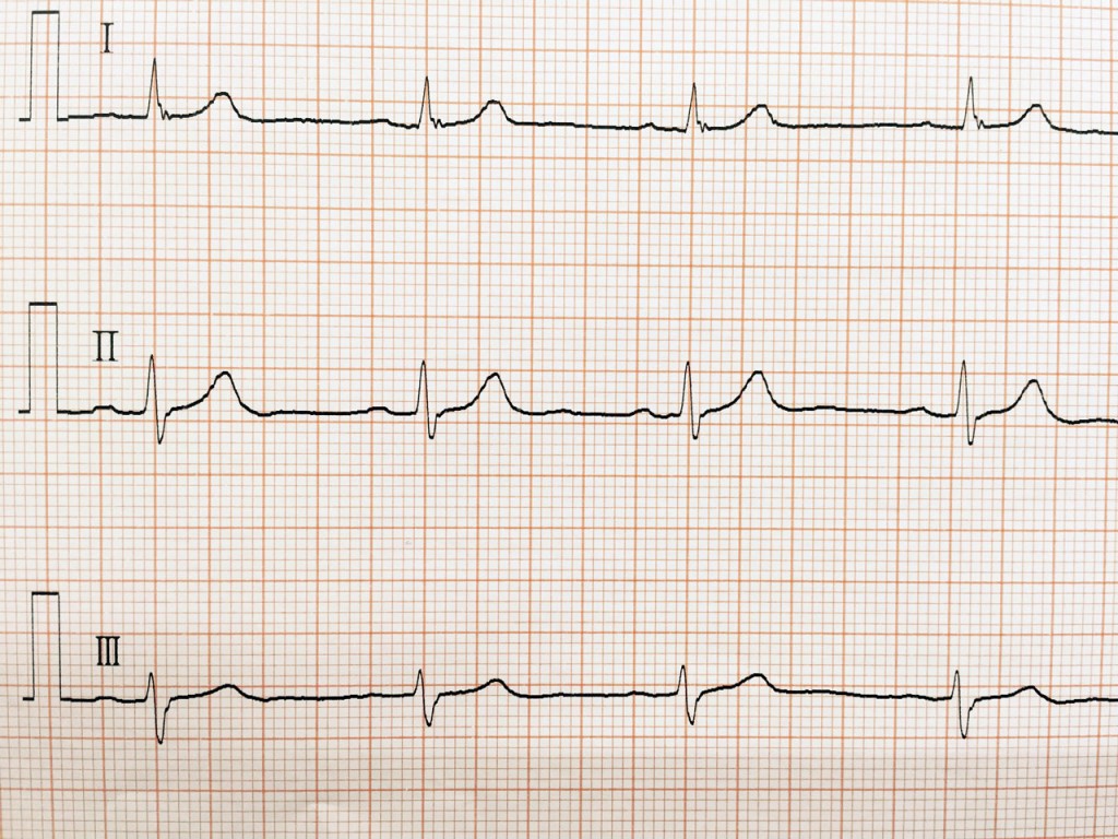 正常洞調律の心電図波形