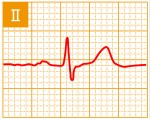標準12誘導心電図 - 標準12誘導の基本波形 - 2