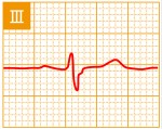 標準12誘導心電図 - 標準12誘導の基本波形 - 3