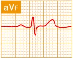 標準12誘導心電図 - 標準12誘導の基本波形 - 6