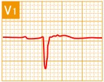 標準12誘導心電図 - 標準12誘導の基本波形 - 7