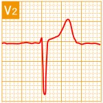 標準12誘導心電図 - 標準12誘導の基本波形 - 8