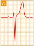 標準12誘導心電図 - 標準12誘導の基本波形 - 9