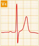 標準12誘導心電図 - 標準12誘導の基本波形 - 10
