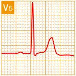 標準12誘導心電図 - 標準12誘導の基本波形 - 11