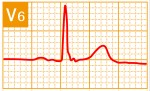 標準12誘導心電図 - 標準12誘導の基本波形 - 12