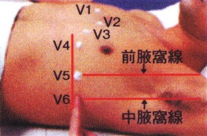 標準12誘導心電図 - V1〜V6の電極位置