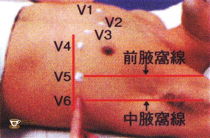 心電図 12 貼り 方 誘導