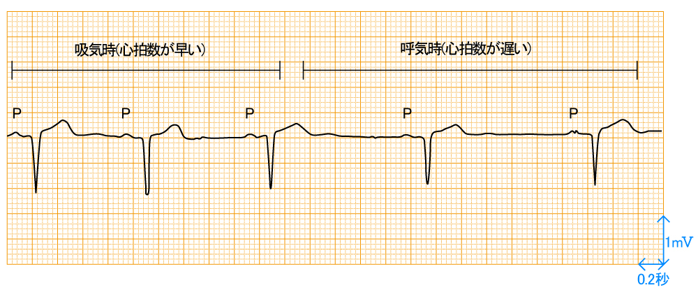 洞性不整脈