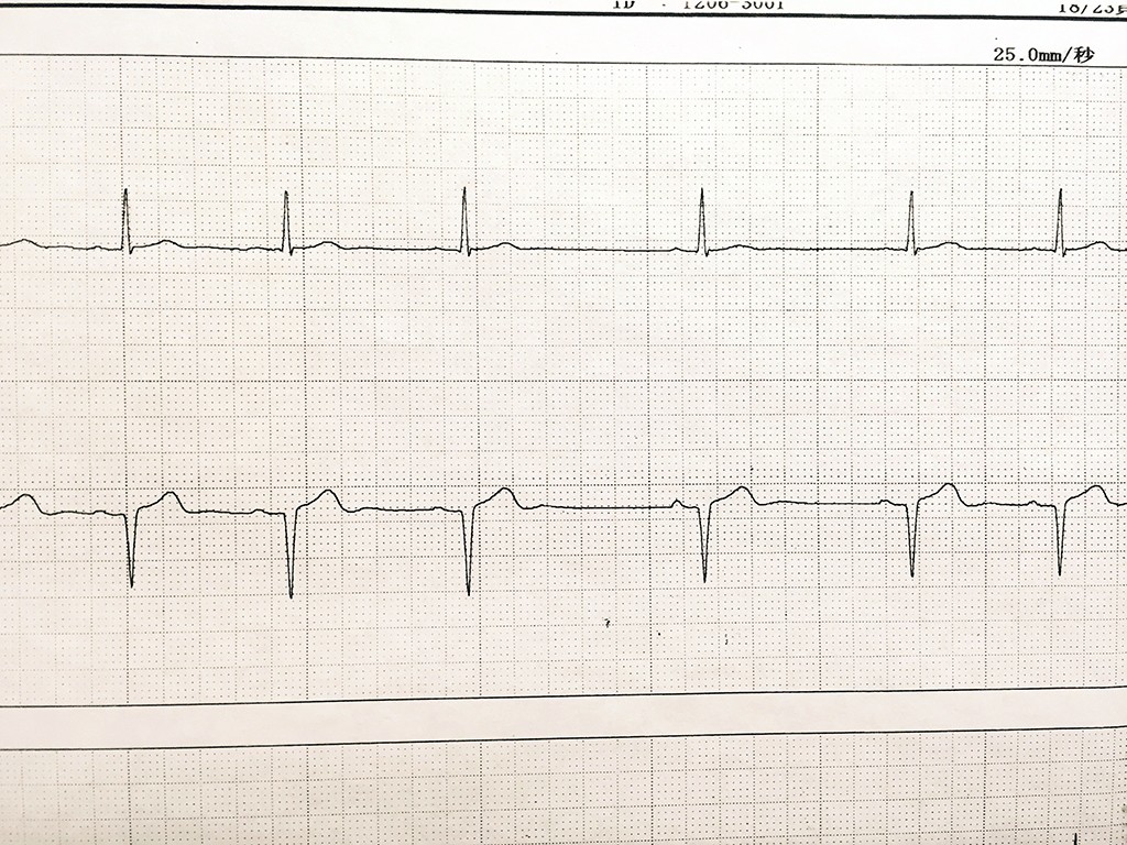 洞性不整脈の実波形