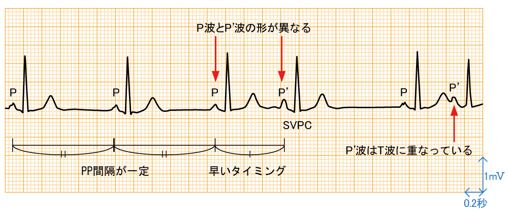 上室期外収縮 - 波形と特徴