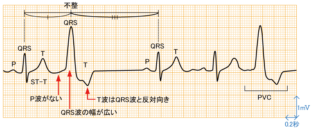 心室期外収縮 - 波形と特徴