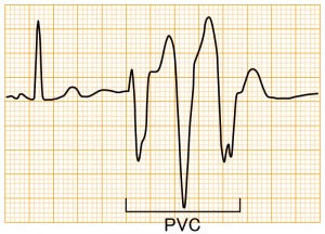 心室期外収縮 - PVC3連発の波形と特徴