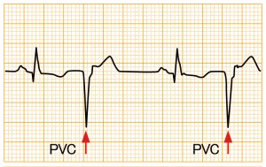 心室期外収縮 - PVC2段脈の波形と特徴