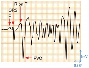 心室期外収縮 - R on Tの波形と特徴