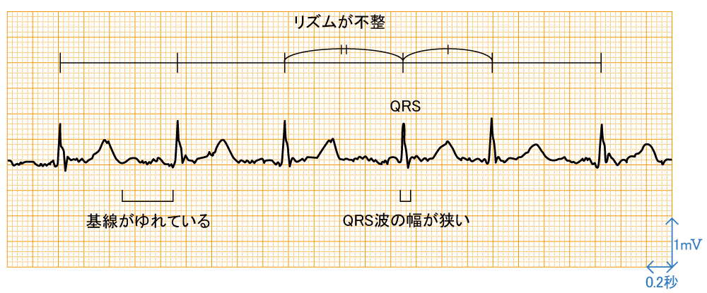 心房細動 - 波形と特徴