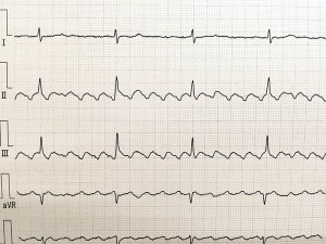 心房粗動の実波形