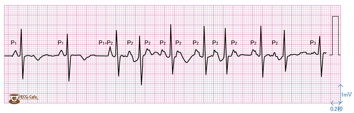 心房頻拍 - 波形と特徴
