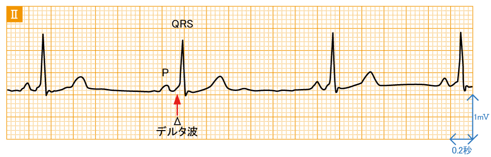 発作性上室頻拍1 - AVRT - 波形と特徴1