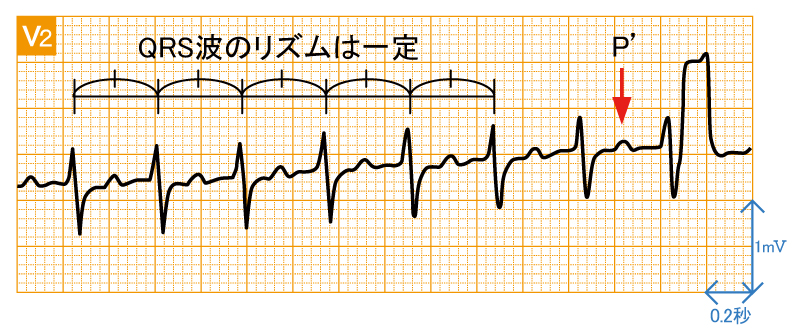 発作性上室頻拍1 - AVRT - 波形と特徴2