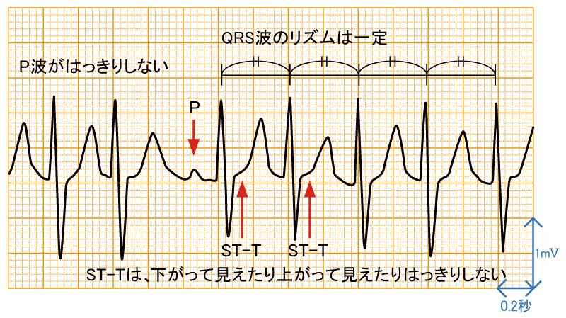 発作性上室頻拍2 - AVNRTの波形と特徴 - 1