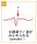 発作性上室頻拍2 - AVNRTの波形と特徴 - 2