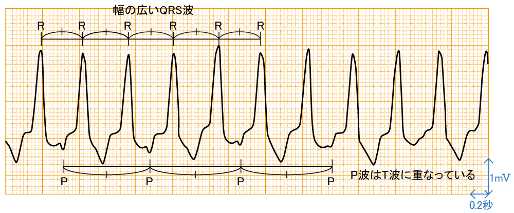 心室頻拍 - 波形と特徴