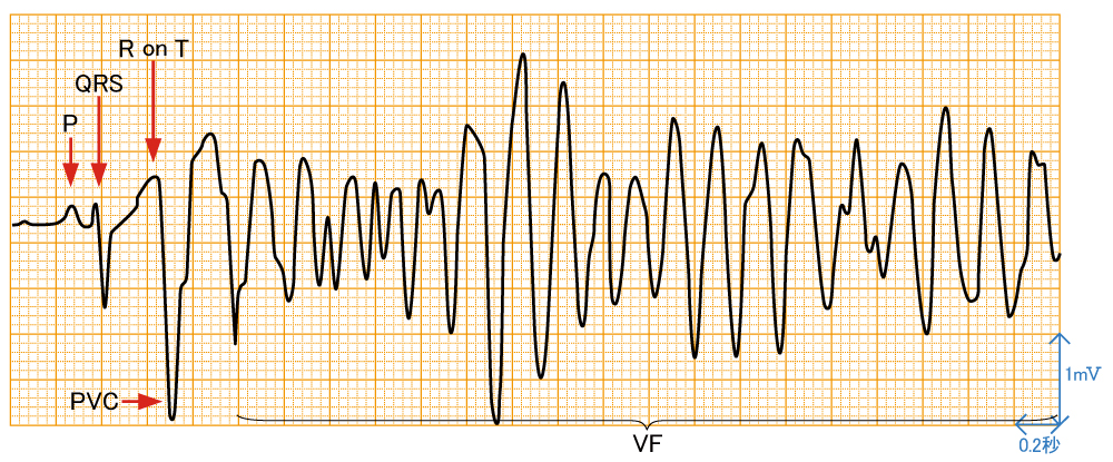 心室細動 - 波形と特徴
