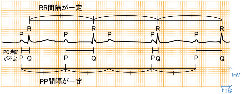 房室ブロック - 完全房室ブロックの波形と特徴