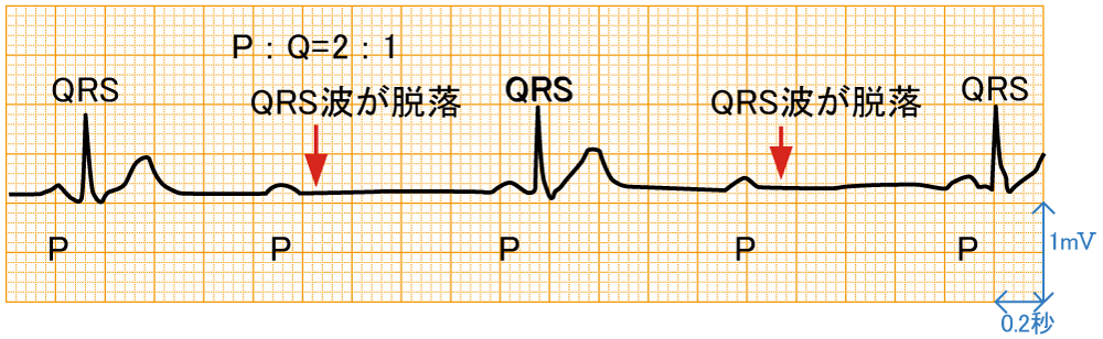 房室ブロック - 高度房室ブロックの波形と特徴
