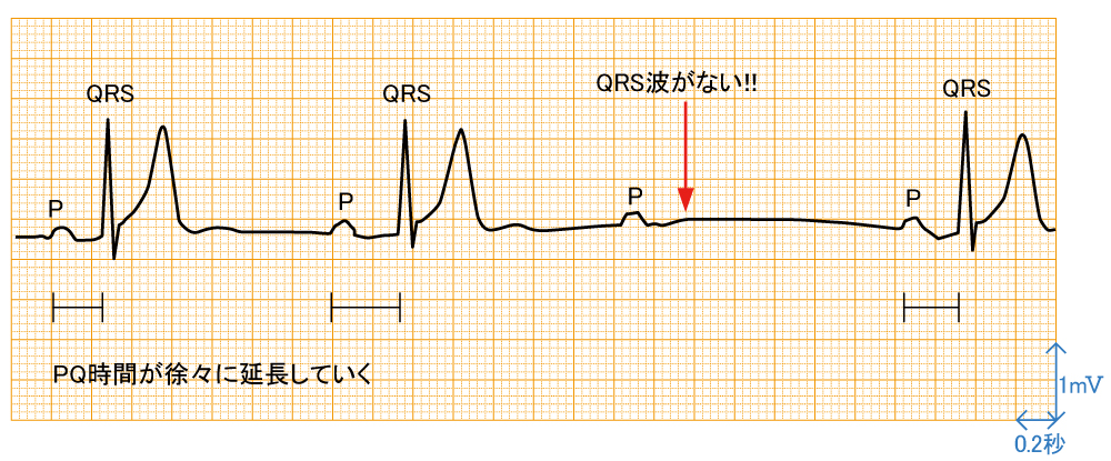 房室ブロック - ウェンケバッハ型房室ブロックの波形と特徴