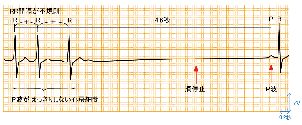 洞不全症候群 - 波形と特徴