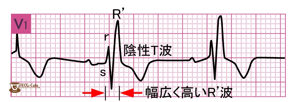 完全 右 脚 ブロック