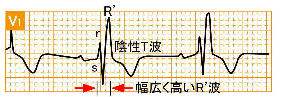 脚ブロック - 完全右脚ブロックの波形と特徴 - 1