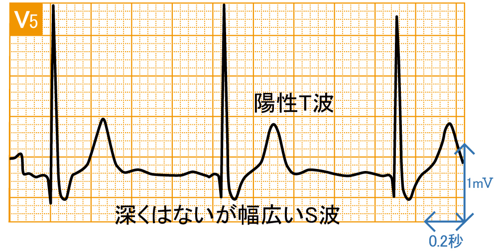 脚ブロック - 完全右脚ブロックの波形と特徴 - 2