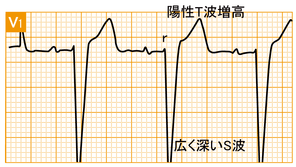 脚ブロック - 完全左脚ブロックの波形と特徴 - 1