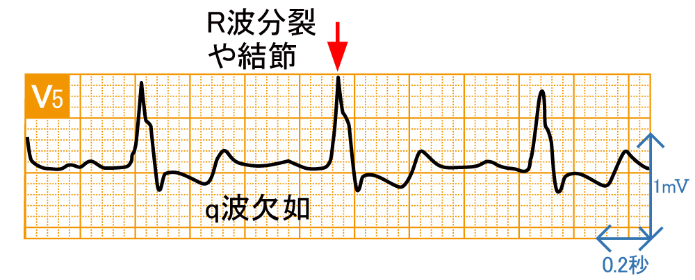 脚ブロック - 完全左脚ブロックの波形と特徴 - 2