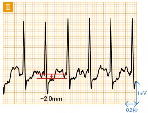 狭心症 - 運動負荷による波形の変化 - 2