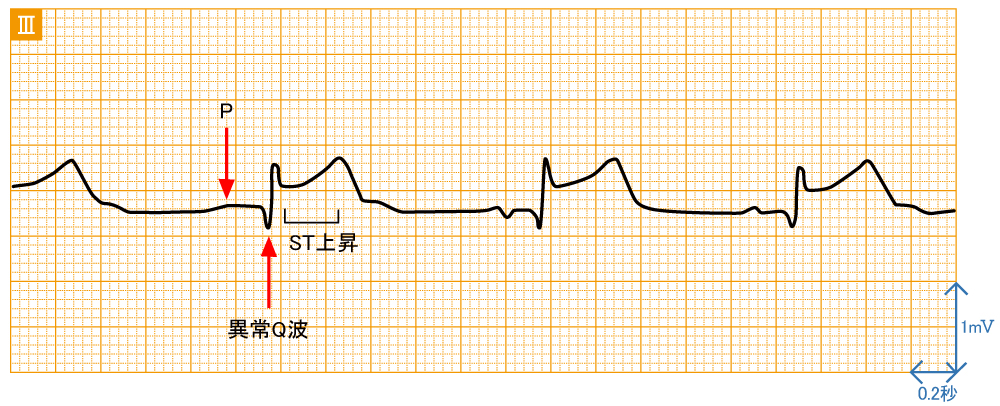 急性心筋梗塞 - 右冠動脈閉塞の波形と特徴