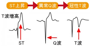 急性心筋梗塞 - 心電図の経時的特徴