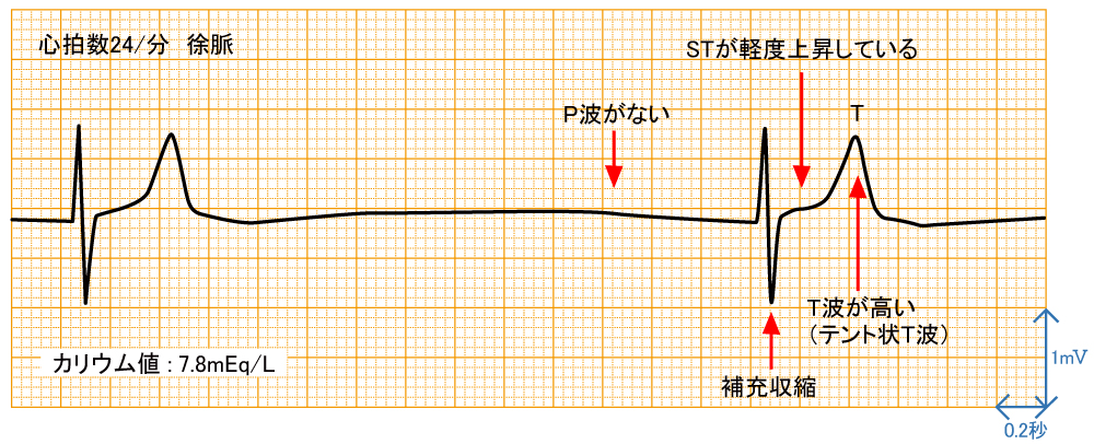 高カリウム結症 - 波形と特徴