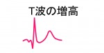 高カリウム結症 - 診断のポイント - 4