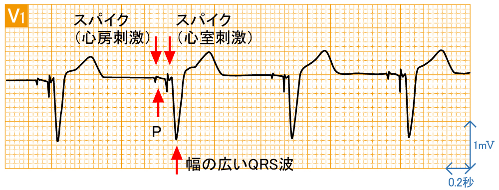 ペースメーカ - DDDの波形と特徴