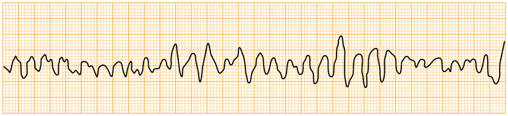 緊急度の高い不整脈 - VF