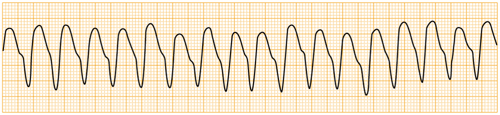 緊急度の高い不整脈 - pulsless VT