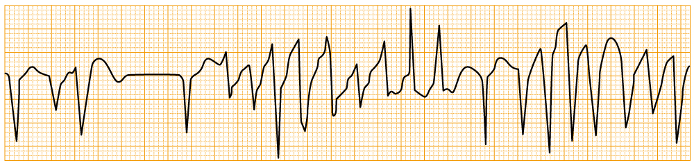 緊急度の高い不整脈 - トルサード・ド・ポアンツ