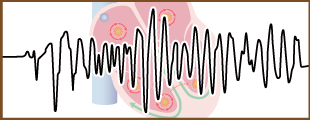 不整脈の種類のイメージ