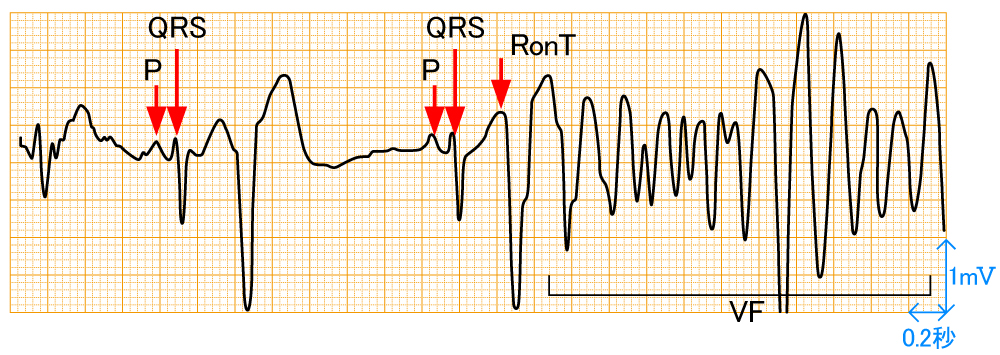 アーチファクト - 心室細動の波形と特徴