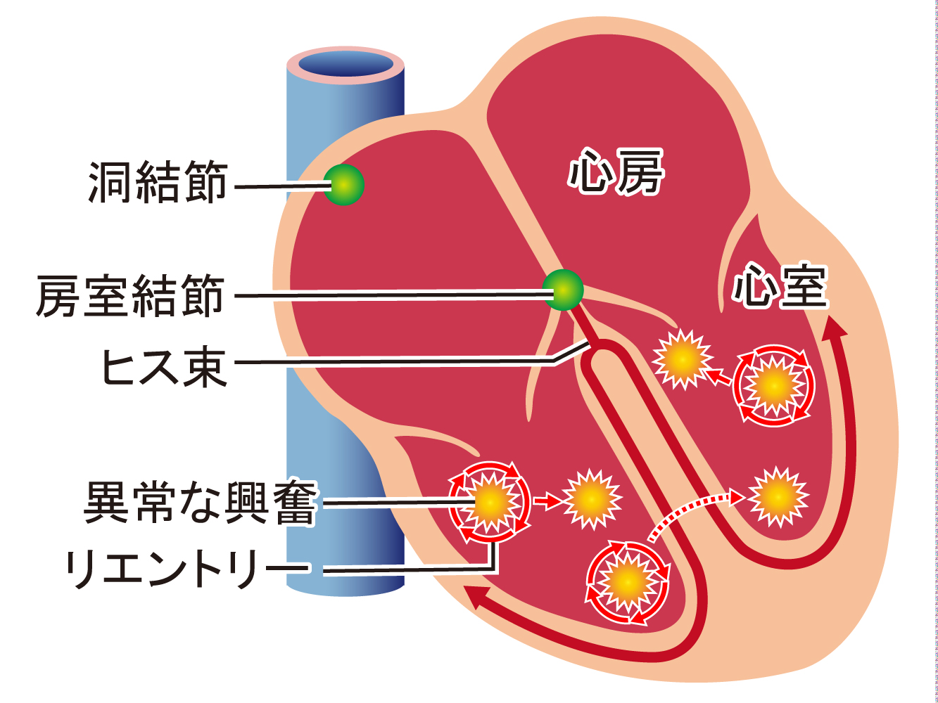 医師は多形性心室頻拍をどのように診断し、治療するのでしょうか?